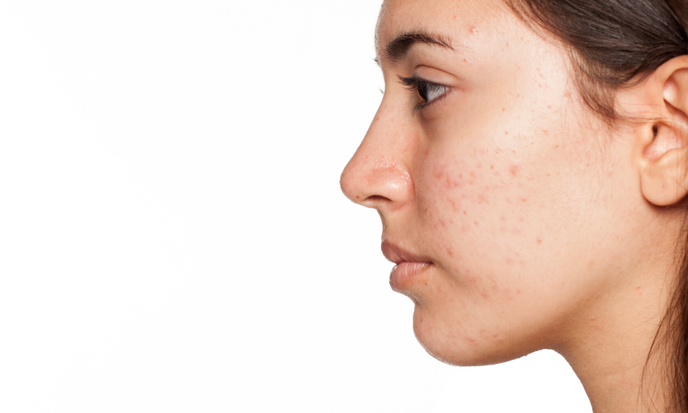Rosalique,Comment traiter l’acné naturellement ?